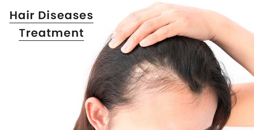 Hair Loss Treatment in Ahmedabad